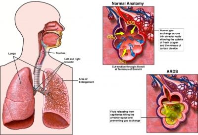Nursing Diagnosis For Respiratory Distress 85