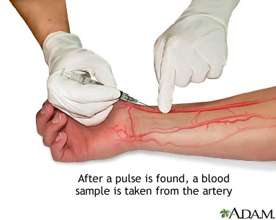 Arterial Blood Gas Analysis - RNpedia