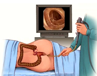 colonoscopy nursing rnpedia results abnormal interventions