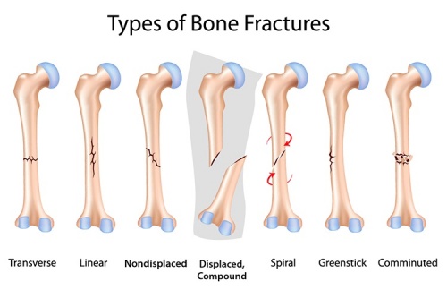 Fractures Nursing Management - RNpedia