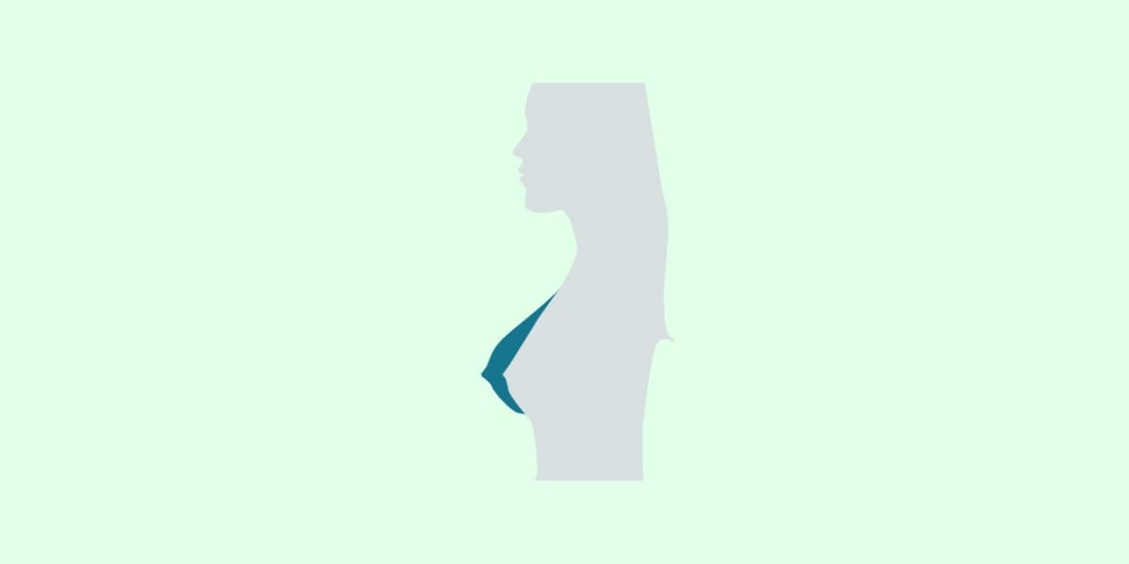 Augmentation Mammoplasty - RNpedia