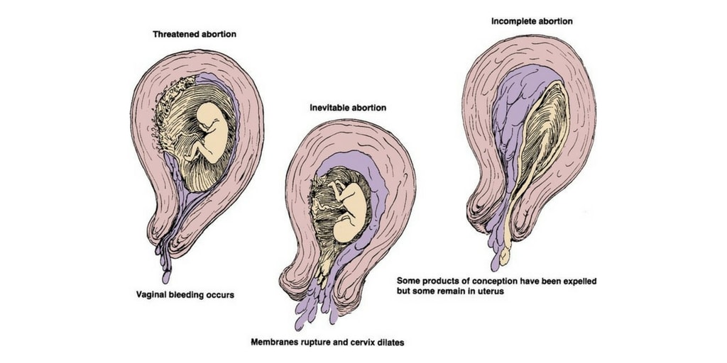 Spontaneous Abortion Nursing Management RNpedia.