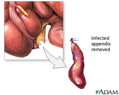Appendectomy (surgical removal of the appendix)