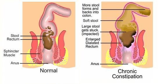 Constipation