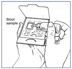 Hemoccult Stool Specimen. Hemoccult II SENSA Beckman 