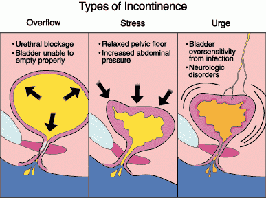 functional incontinence