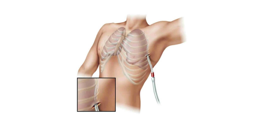 Chest tube insertion is a procedure commonly performed by residents and fel...