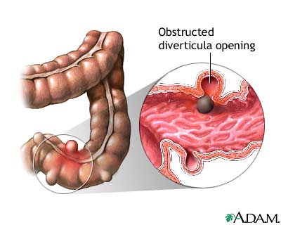 Diverticulitis and Diverticulosis Nursing Management - RNpedia