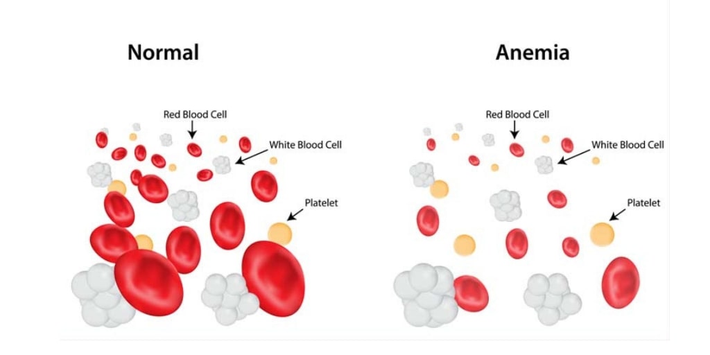 Iron Deficiency Anemia Nursing Care Plan Management Rnpedia