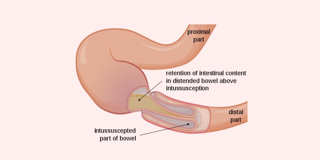 Intussusception Nursing Care Plan Management Rnpedia